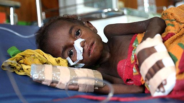 7 Langkah Praktis Atasi Darurat Gizi Buruk Cara Saya