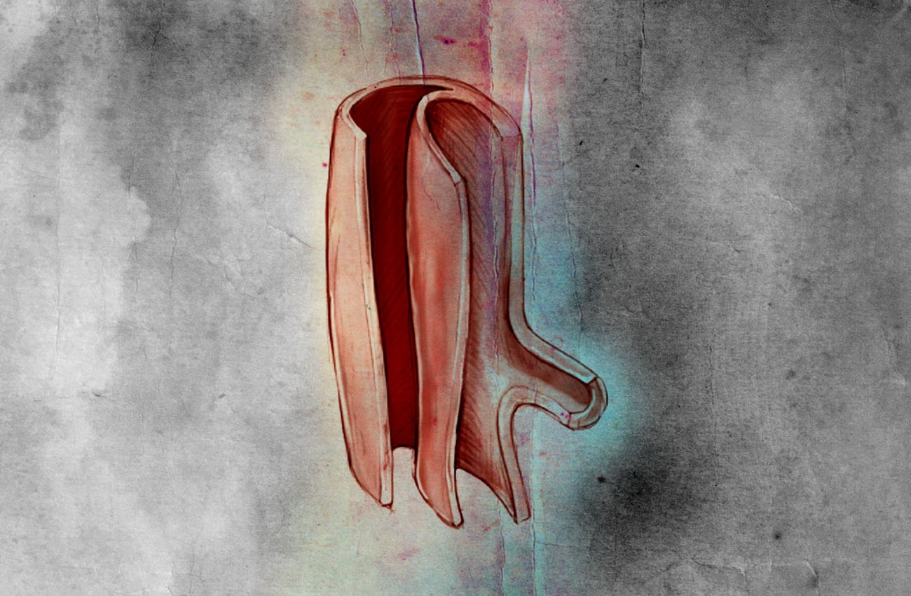 Lolos dari Maut (6): Hampir Saja Skenario "By Pass" di Lever